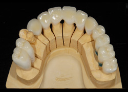 インプラントと天然歯の混在 審美症例2
