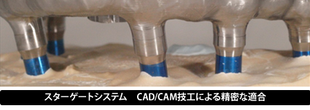 スターゲート CAD/CAM技工による精密な適合