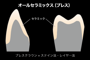 オールセラミックス （プレス）