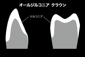 オールジルコニアクラウン