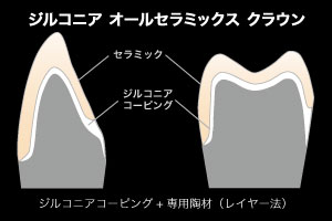 ジルコニア オールセラミック