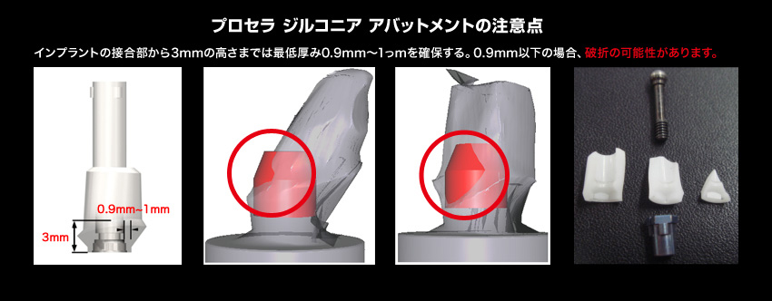 プロセラ ジルコニアアバットメントの注意点