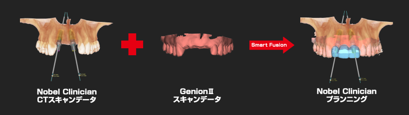 ノーベルクリニシャンとジェニオン2によるプランニング